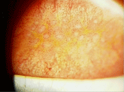 eye